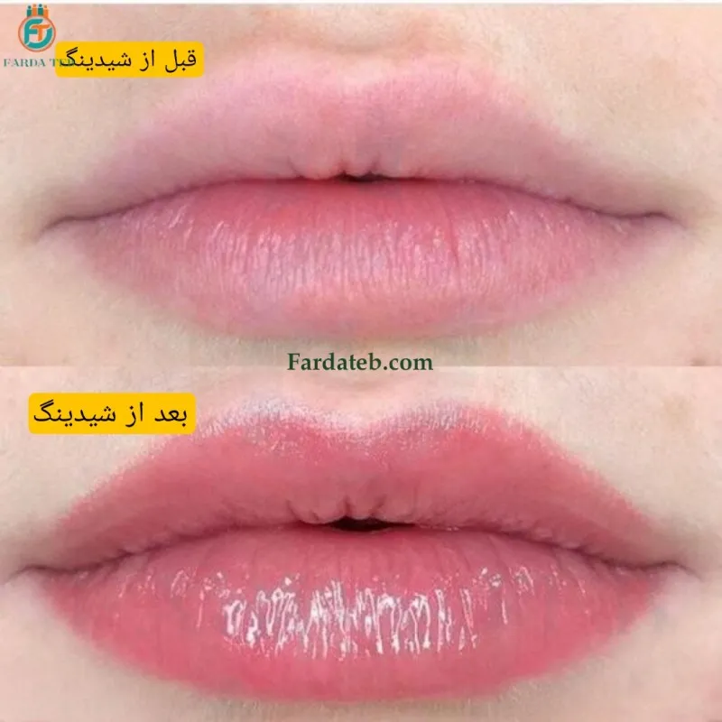 شیدینگ لب چیست؟ مراحل، ماندگاری، عوارض و مراقبتها 2 شیدینگ لب چیست